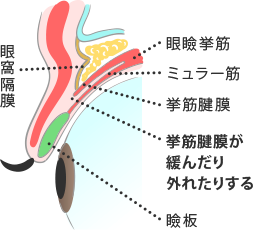 老化が原因の眼瞼下垂